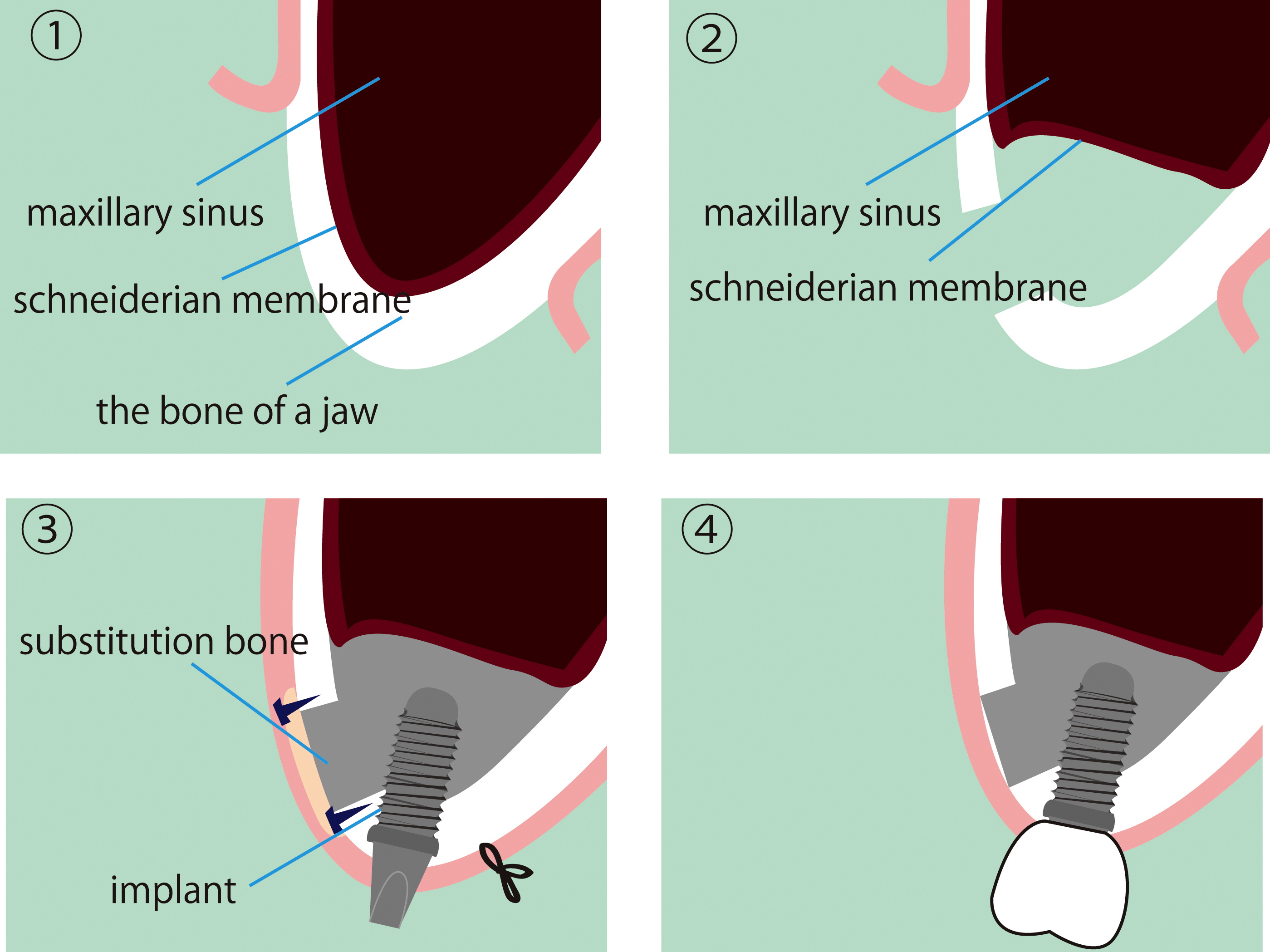 How Is A Sinus Lift Procedure Done