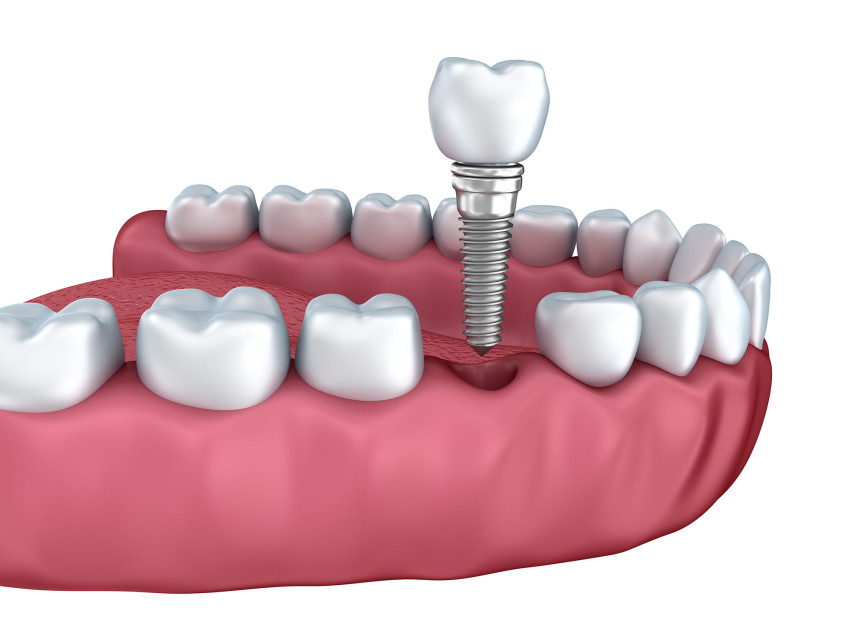 Dental Implants Tooth Extraction