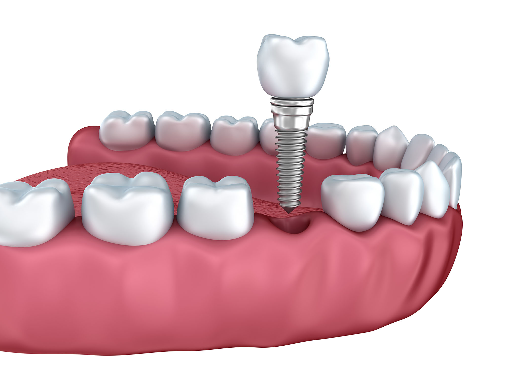 appearance-of-a-healing-tooth-extraction-macquarie-park