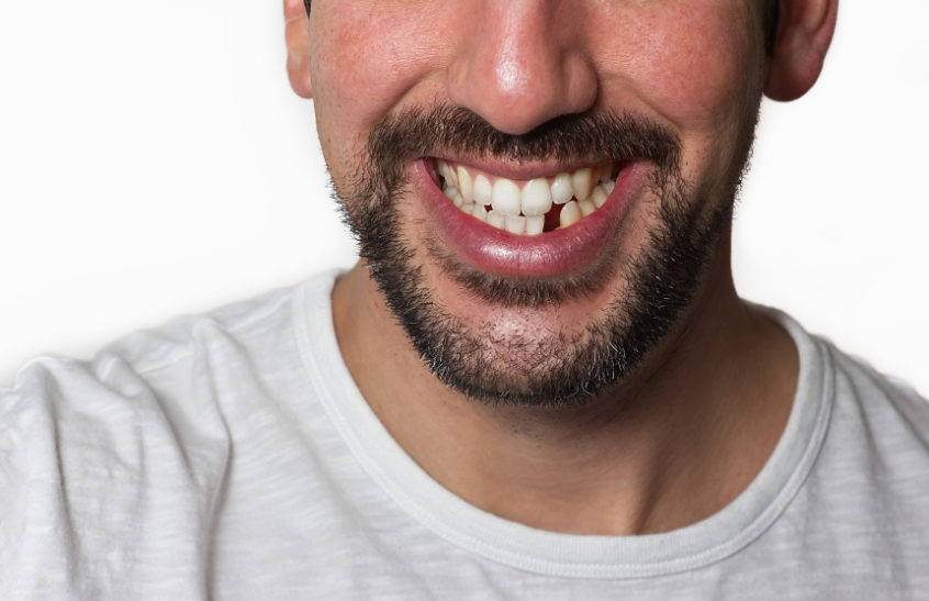 Man missing his tooth needing porcelain fixed bridge