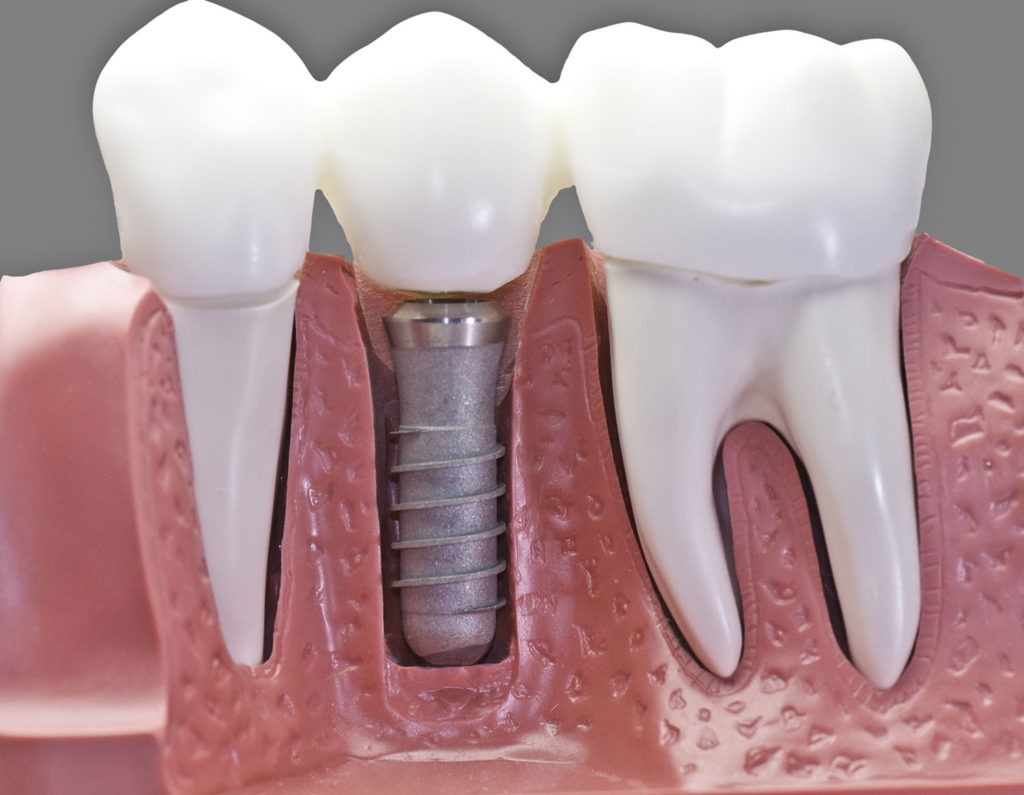 Dental Implants Baltimore at Towson's GBP Dental