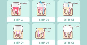 root canal therapy steps