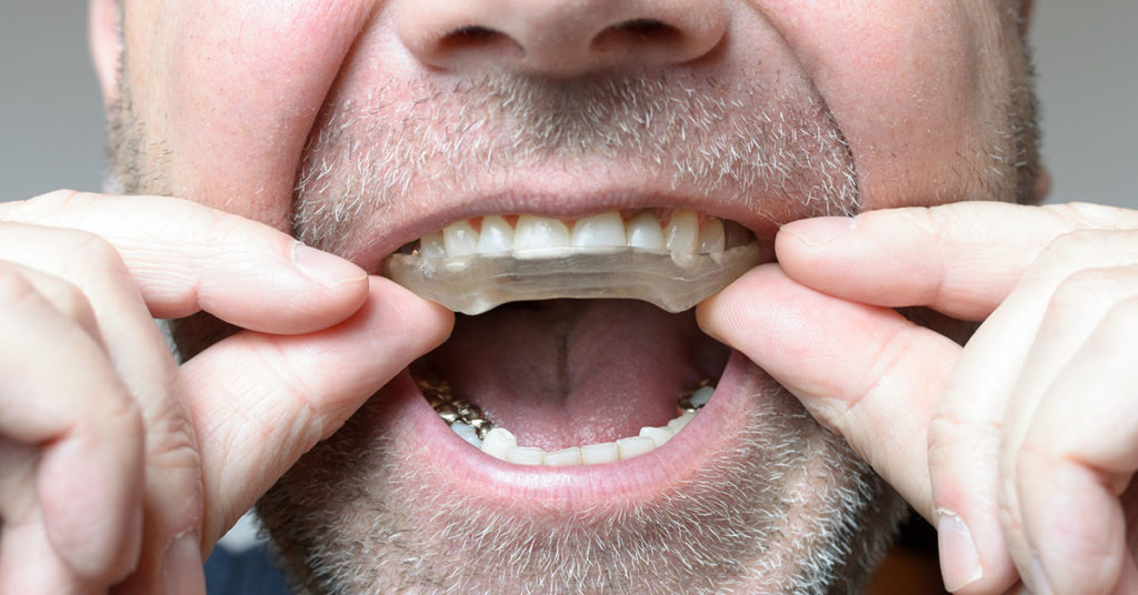 Bruxism Mouth Guards