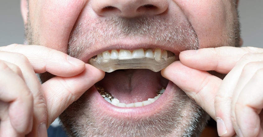 bruxism mouth guards